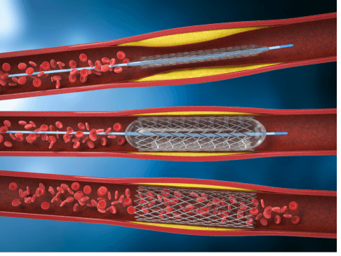 Angioplastia coronária