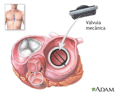 Valva Mecânica