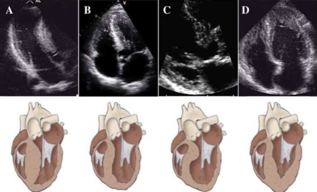 Padrões de Miocardiopatia Hipertrófica