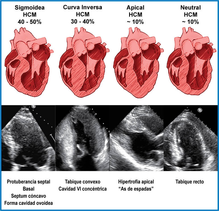 Fenótipos de Miocardiopatia Hipertrófica