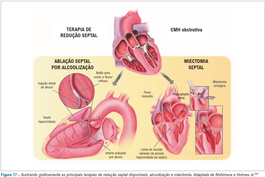 Redução Septal de Miocardiopatia Hipertrófica